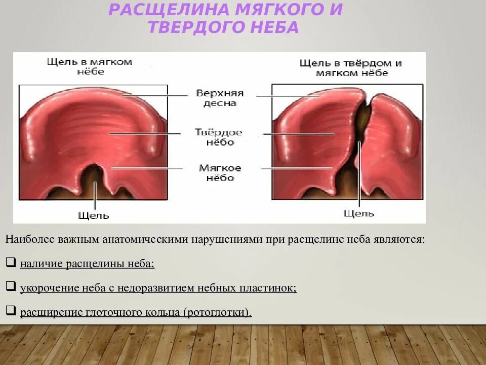 Расщелина мягкого и твердого неба фото Фото ТВЕРДОЕ НЕБО