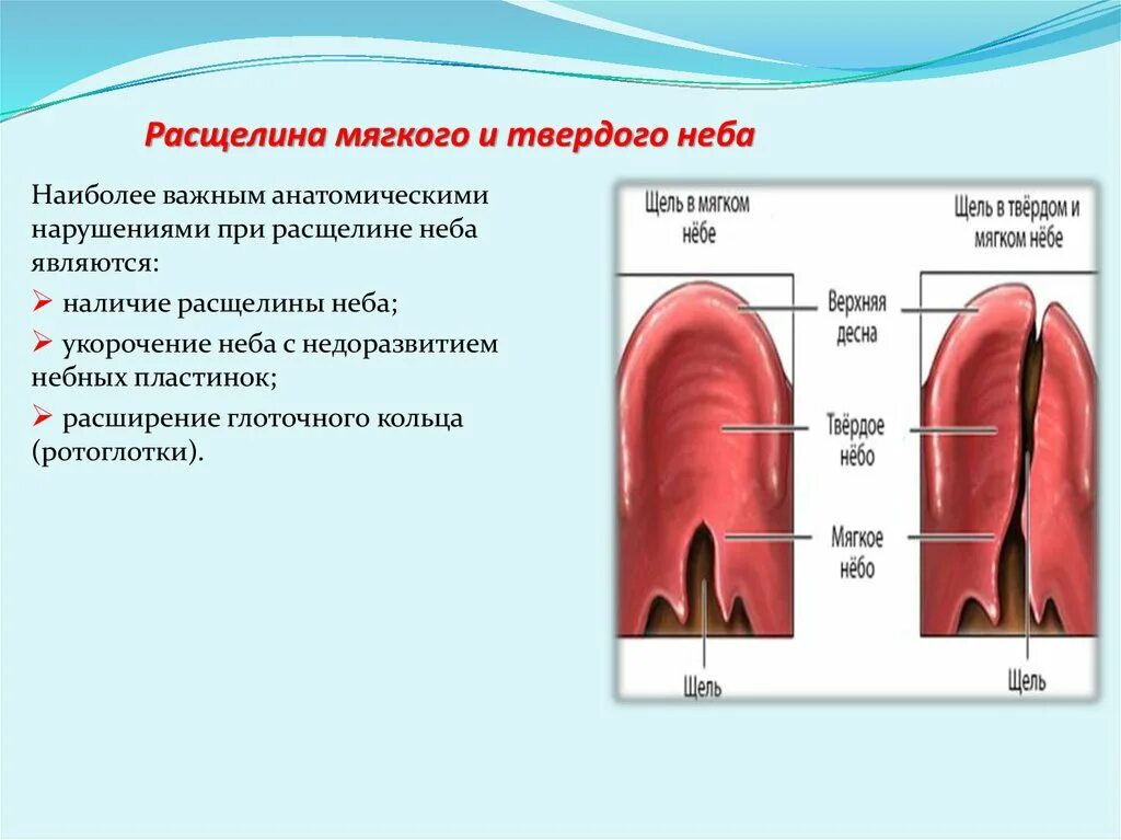 Расщелина мягкого и твердого неба фото Расщелина верхней губы и нёба - презентация онлайн