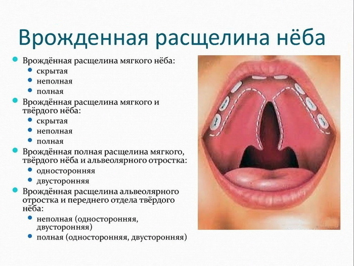 Расщелина мягкого и твердого неба фото Каппацизм у детей и взрослых - причины, диагностика и лечение