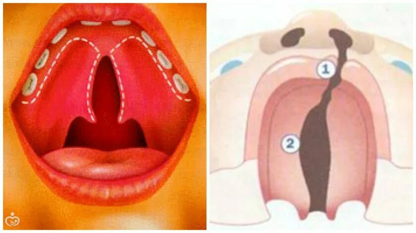 Расщелина мягкого и твердого неба фото Заячья губа рисунок