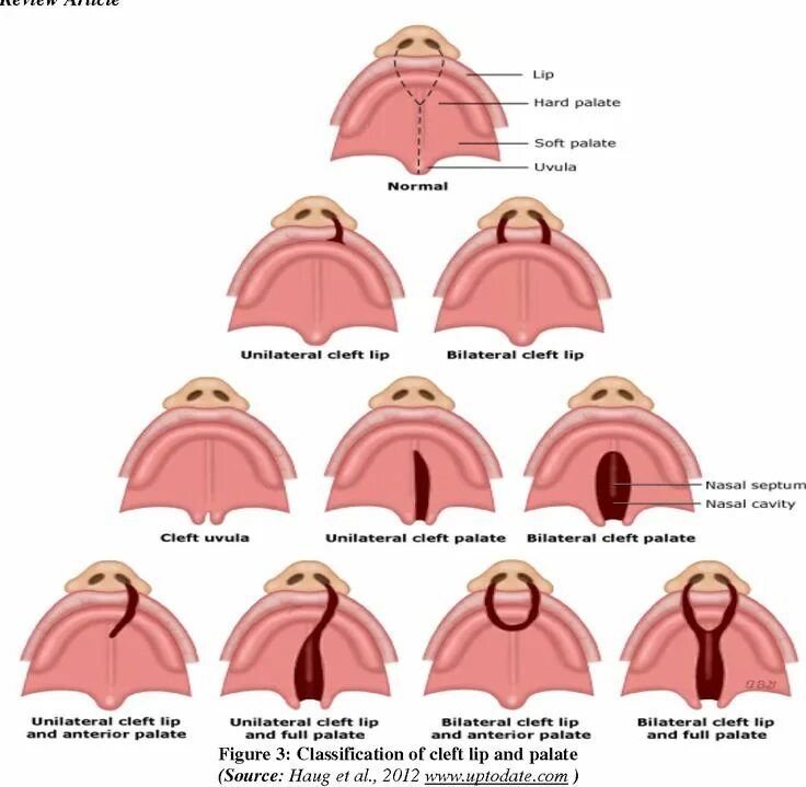 Расщелина мягкого и твердого неба фото Classification of Cleft Lip and Palate Color Diagram