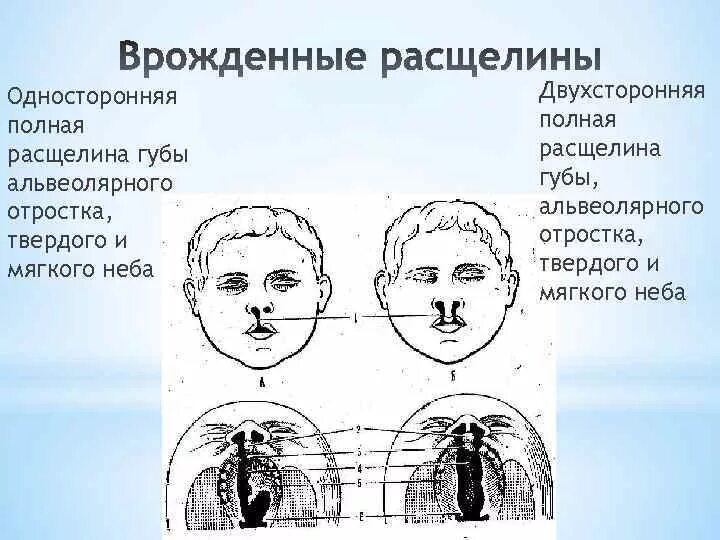 Расщелина мягкого и твердого неба фото Раздел 3 Определение и характеристика различных форм речевых