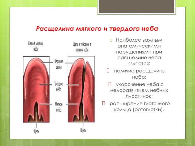 Расщелина мягкого неба фото Расщелина верхней губы и нёба презентация, доклад