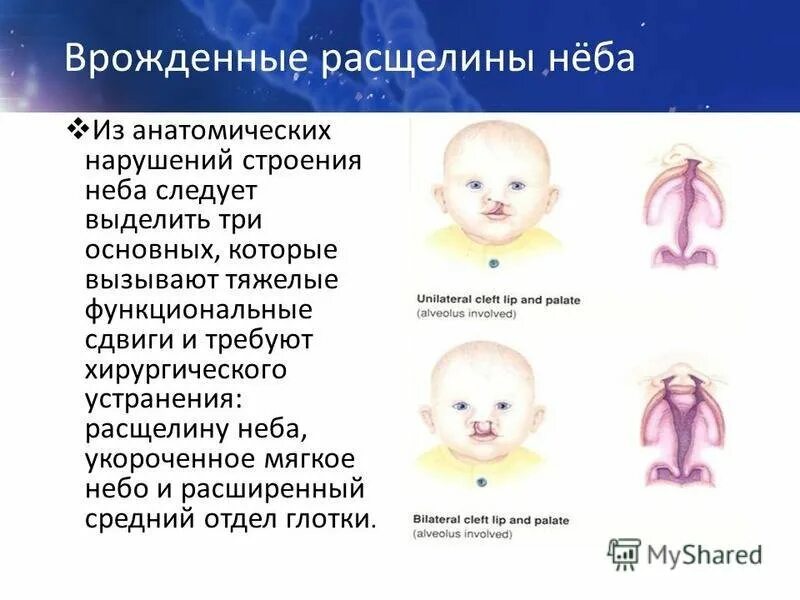 Расщелина мягкого неба фото Классификация врожденных расщелин