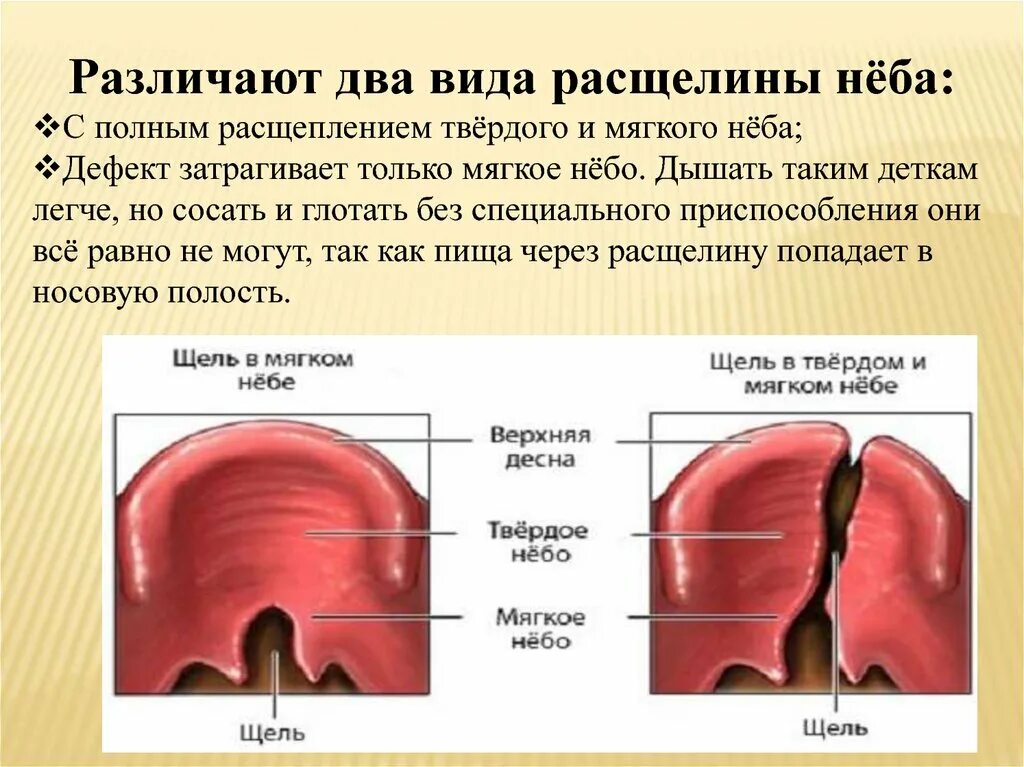 Расщелина мягкого неба фото Дефект неба: найдено 81 изображений