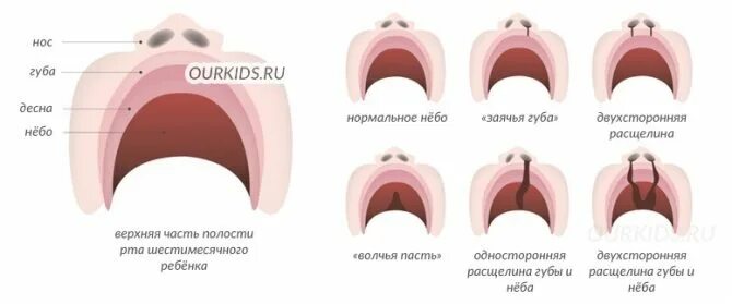 Расщелина мягкого неба фото Картинки расщелина мягкого неба (69 фото)