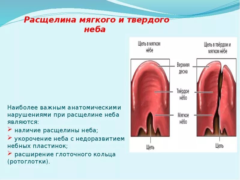 Расщелина мягкого неба у новорожденного фото Расщелина верхней губы и нёба