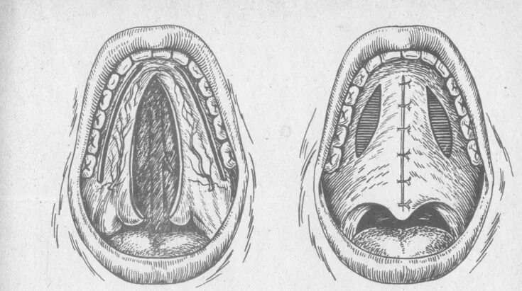 Расщелина неба фото Cleft palate and lips: causes, groups of anomalies, therapeutic approaches - Est