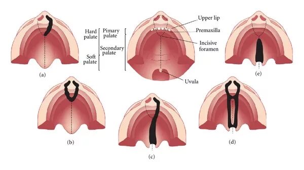 Расщелина неба фото Representation of the most common types of cleft affecting the palate.... Downlo