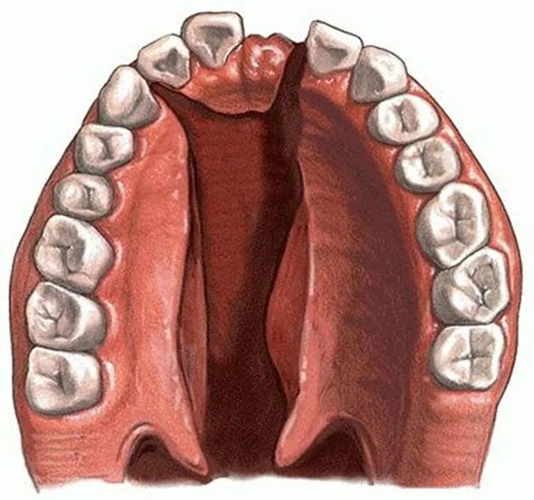 Расщелина неба фото Твёрдое нёбо и его заболевания: симптомы и лечение