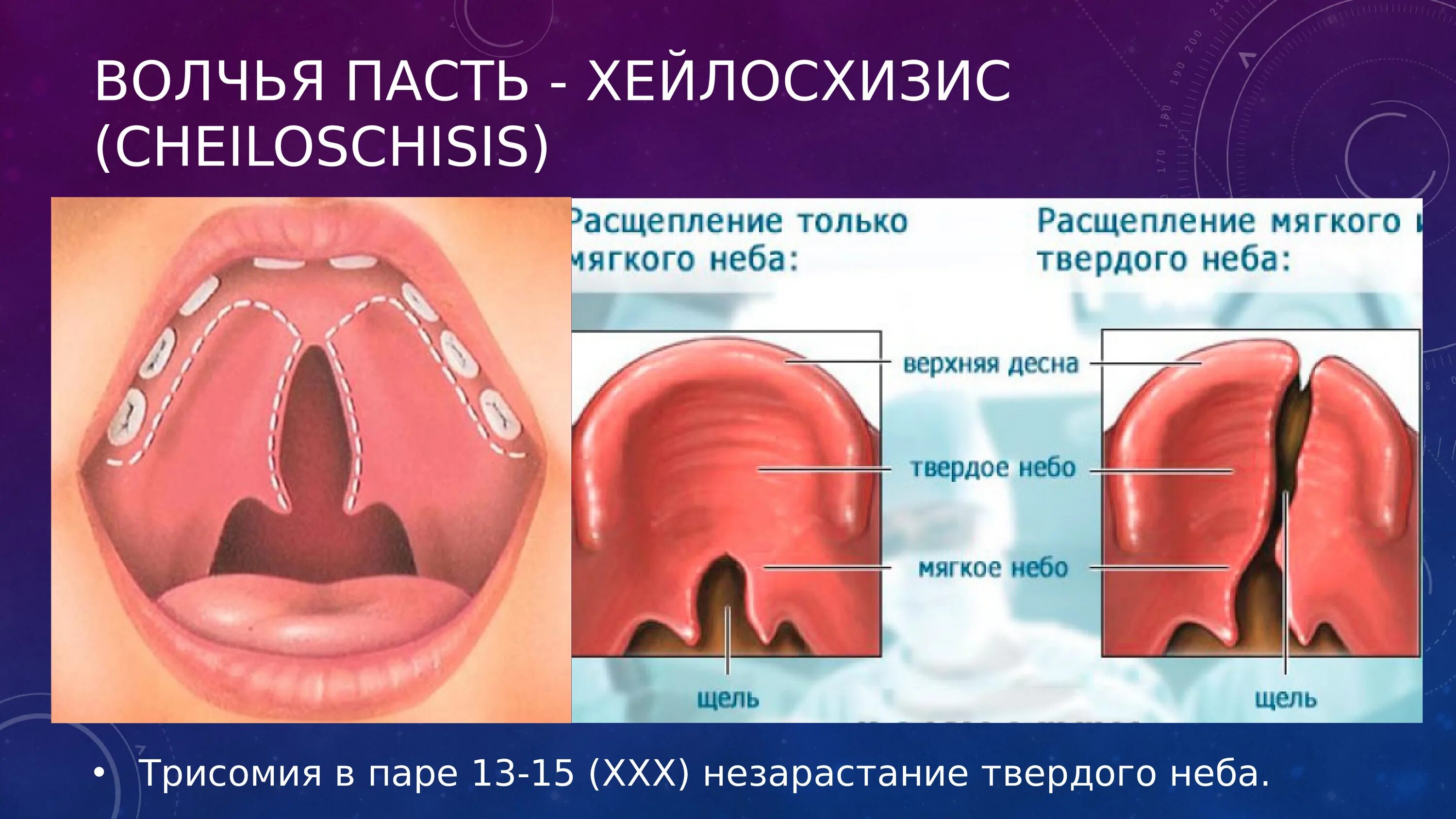 Расщелина неба фото Рисунок волчья пасть