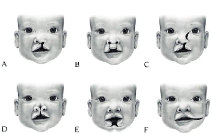 Расщелина неба у новорожденного фото Orofacial clefts: (A) unilateral cleft lip; (B) bilateral cleft lip;... Download