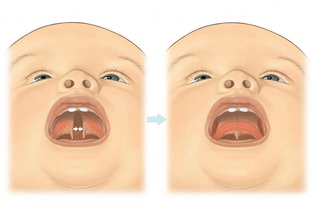 Расщелина неба у новорожденного фото с пояснениями Что такое расщелина твердого неба и как помочь?
