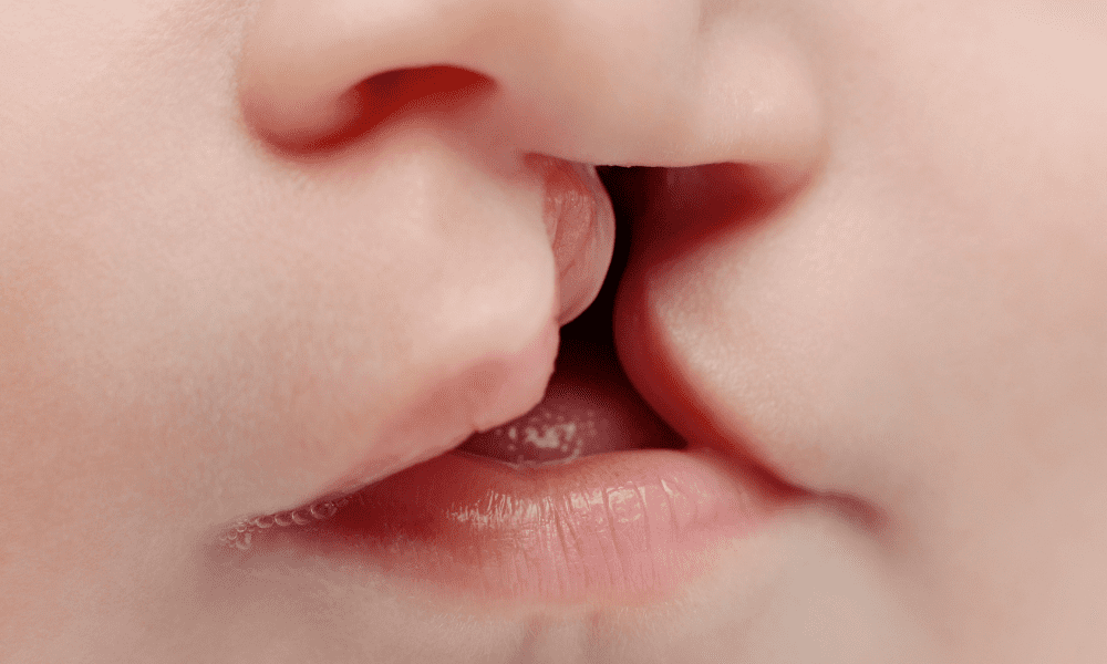 Расщелина верхней губы фото Cleft Lip and Palate - All the Things You Should Know About: Kirkland Premier De