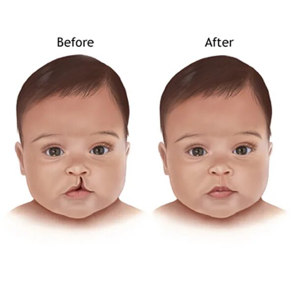 Расщелина верхней губы фото Cleft lip and Cleft Palate - Symptoms and Causes Medtalks