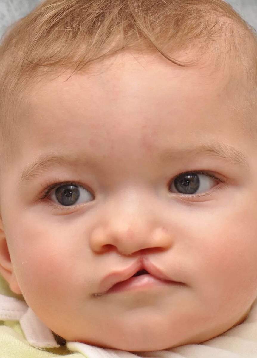 Расщелина верхней губы фото Cleft Lip Hellenic Craniofacial Center