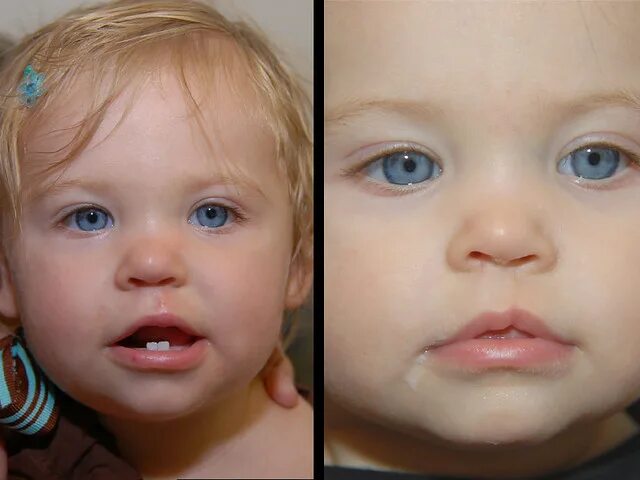 Расщепление неба фото Microform Cleft Lip Repair Surgery at 1 year for a microfo. Flickr