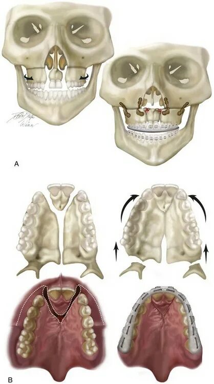 Расщепление неба фото 33: Cleft–Orthognathic Surgery: The Bilateral Cleft Lip and Palate Deformity Poc