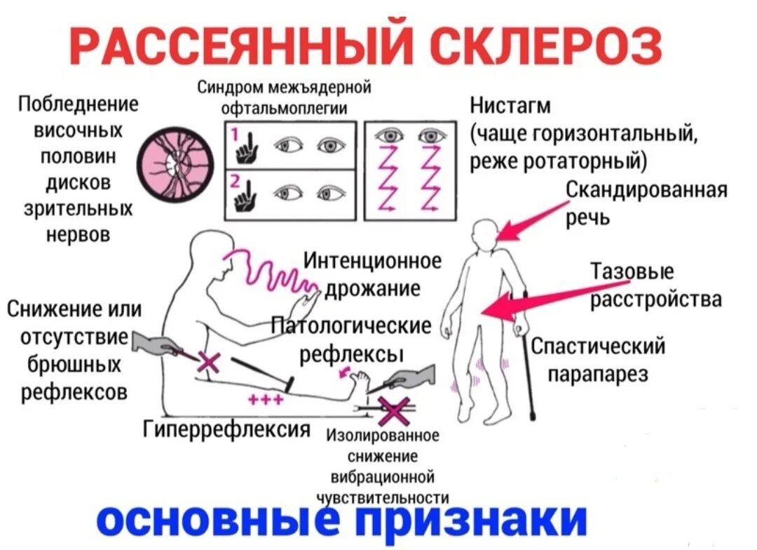 Рассеянный склероз фото больных на последней стадии Склероз рассеянный по жизни читать полностью: найдено 79 картинок