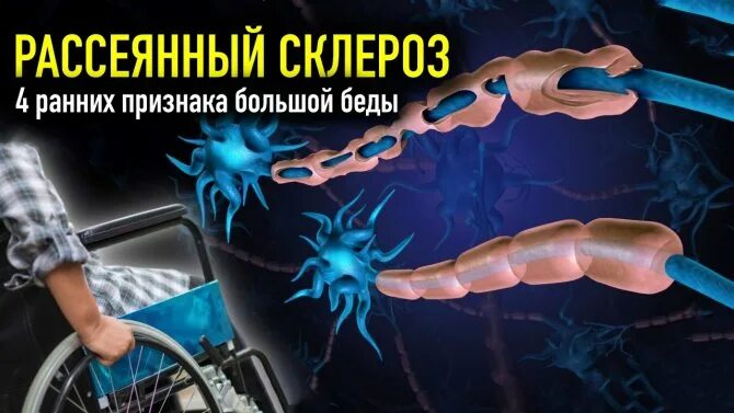 Рассеянный склероз симптомы фото Multiple sclerosis: 4 early signs of complete collapse of the nervous system tha