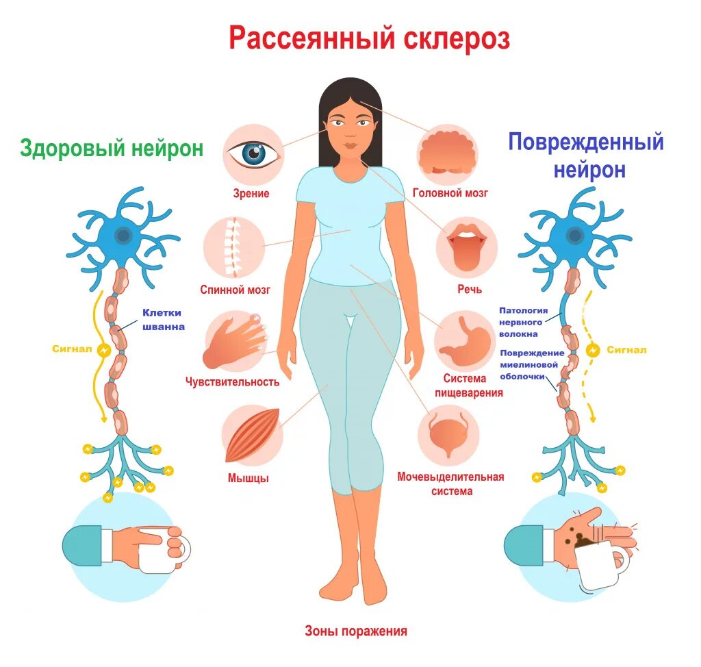 Рассеянный склероз симптомы фото Рассеянный склероз - причины появления, симптомы заболевания, диагностика и спос