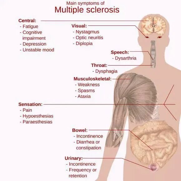 Рассеянный склероз симптомы у женщин фото Pin on multiple sclerosis