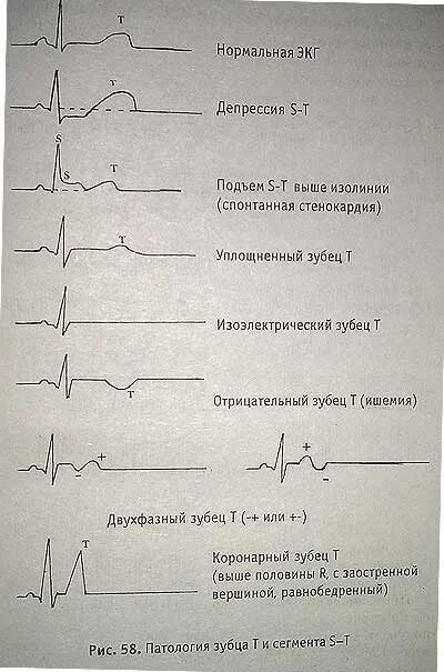 Расшифровать кардиограмму сердца онлайн по фото Практика фельдшера - Портал о скорой помощи и медицине