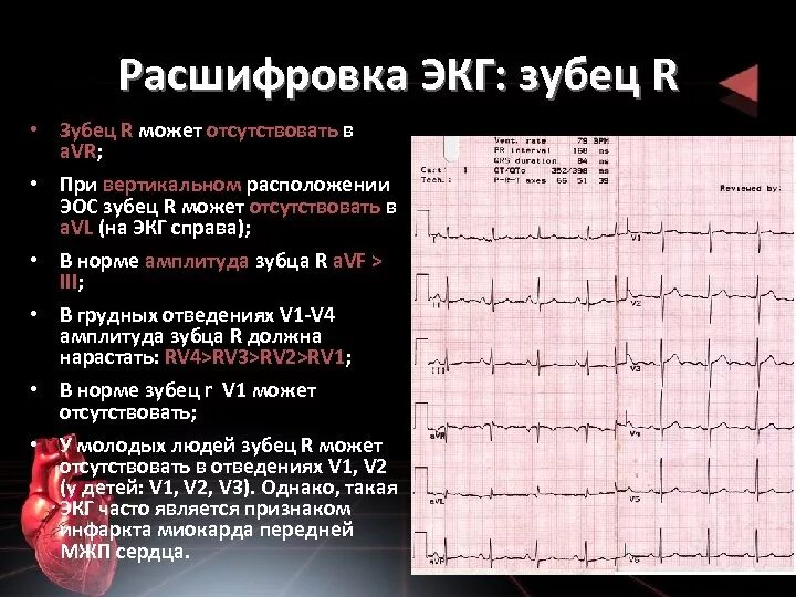 Расшифровать кардиограмму сердца онлайн по фото Калибровка экг