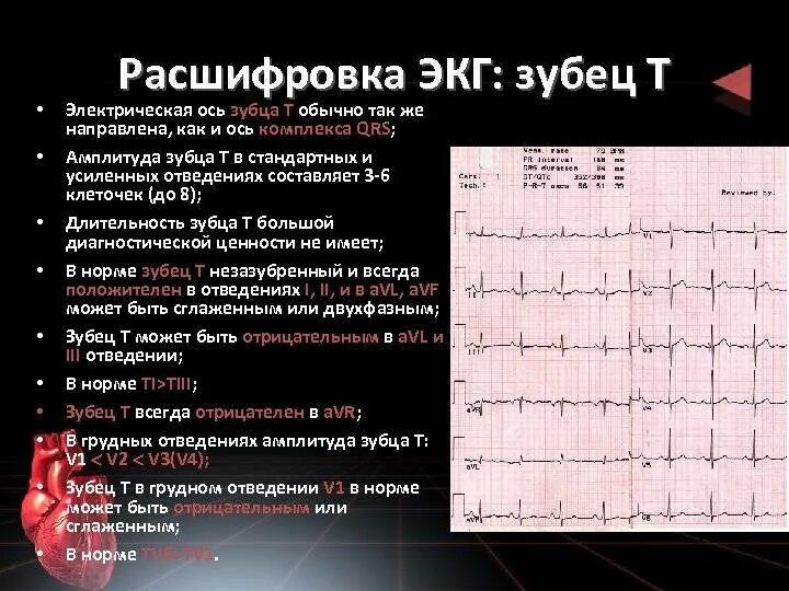 Расшифровать кардиограмму сердца онлайн по фото Картинки ПРИМЕР РАСШИФРОВКИ ЭКГ