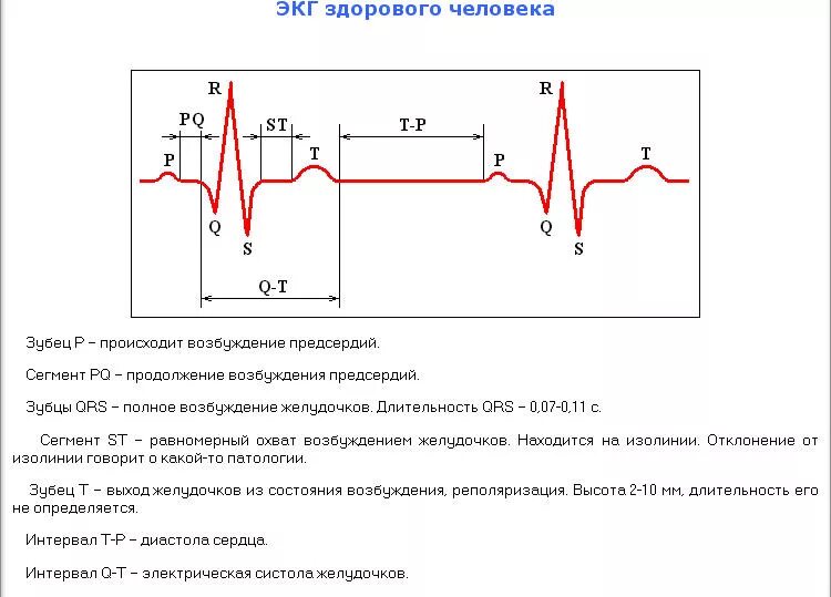 Расшифровать кардиограмму сердца онлайн по фото Картинки РАСШИФРОВКА ЭКГ ДЛЯ ЧАЙНИКОВ С ПРИМЕРАМИ
