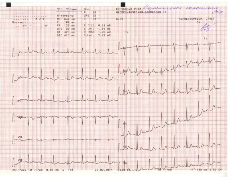 Расшифровать кардиограмму сердца онлайн по фото Помогите расшифровать ЭКГ - Вопрос кардиологу - 03 Онлайн