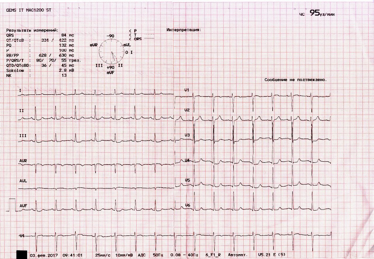 Расшифровка кардиограммы сердца онлайн по фото Помощь в расшифровке ЭКГ - Вопрос кардиологу - 03 Онлайн