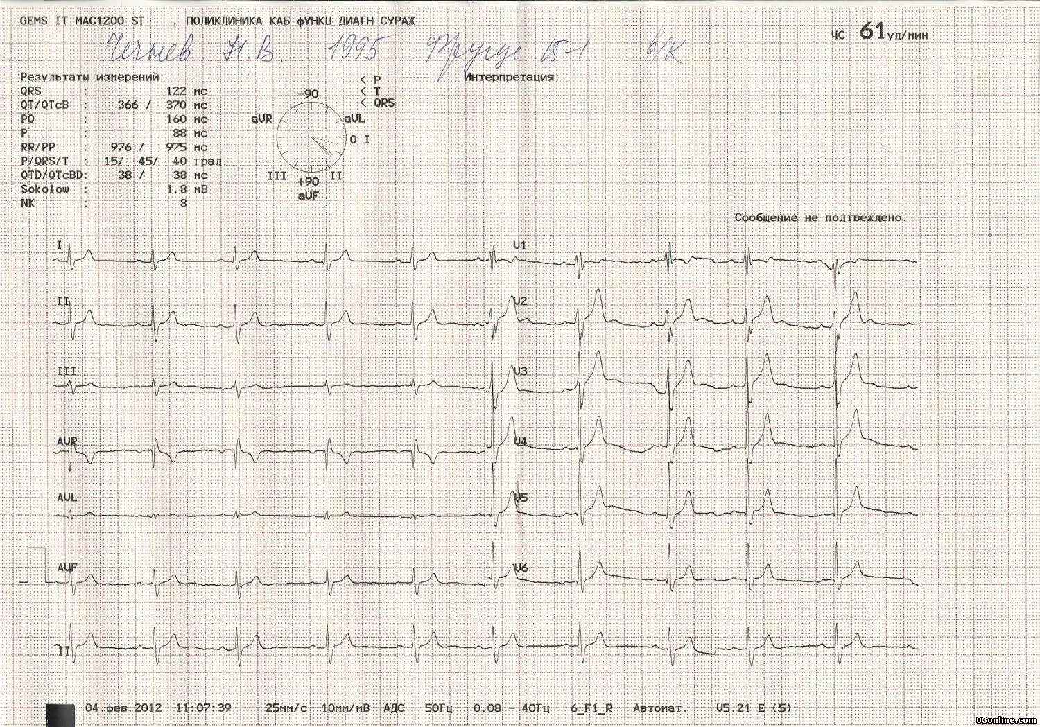 Расшифровка кардиограммы сердца онлайн по фото ЭКГ сердца - Вопрос кардиологу - 03 Онлайн