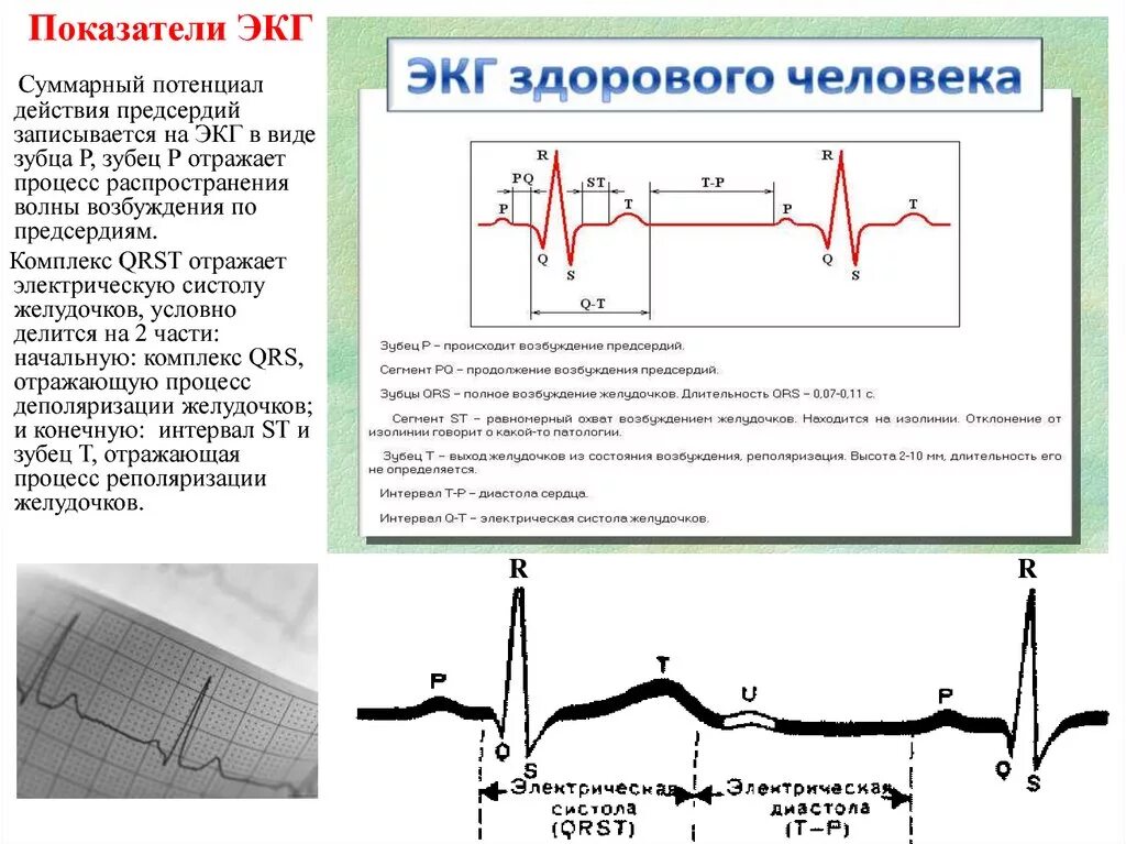 Расшифровка кардиограммы сердца онлайн по фото Картинки ЭКГ ЗДОРОВОГО СЕРДЦА