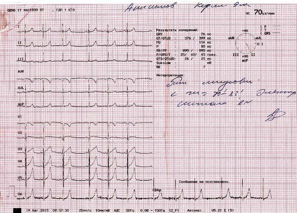 Расшифровка кардиограммы сердца онлайн по фото бесплатно Экг с расшифровкой рядом: найдено 68 изображений