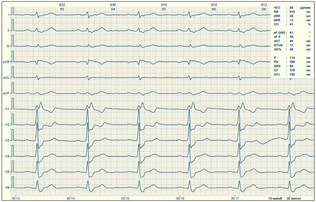 Расшифровка кардиограммы сердца онлайн по фото бесплатно Пришла на медосмотр для ГАИ, а врач: "У вас сердце 70-летнего человека"