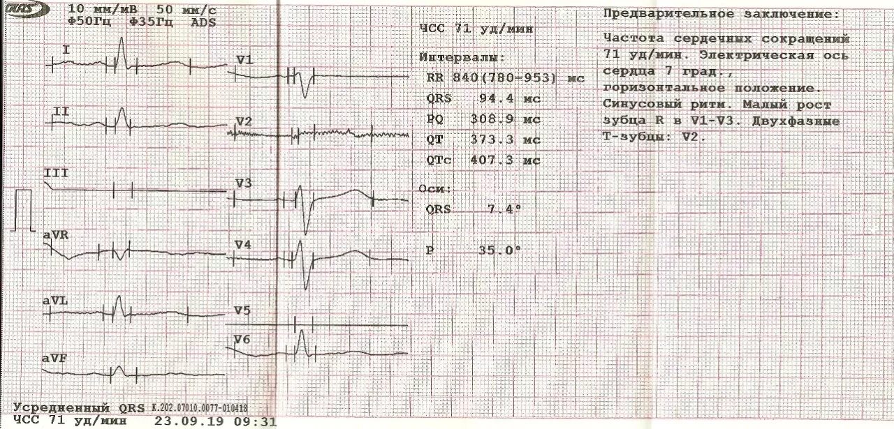 Расшифровка кардиограммы сердца онлайн по фото бесплатно Очень нужна расшифровка кардиограммы! - Вопрос кардиологу - 03 Онлайн