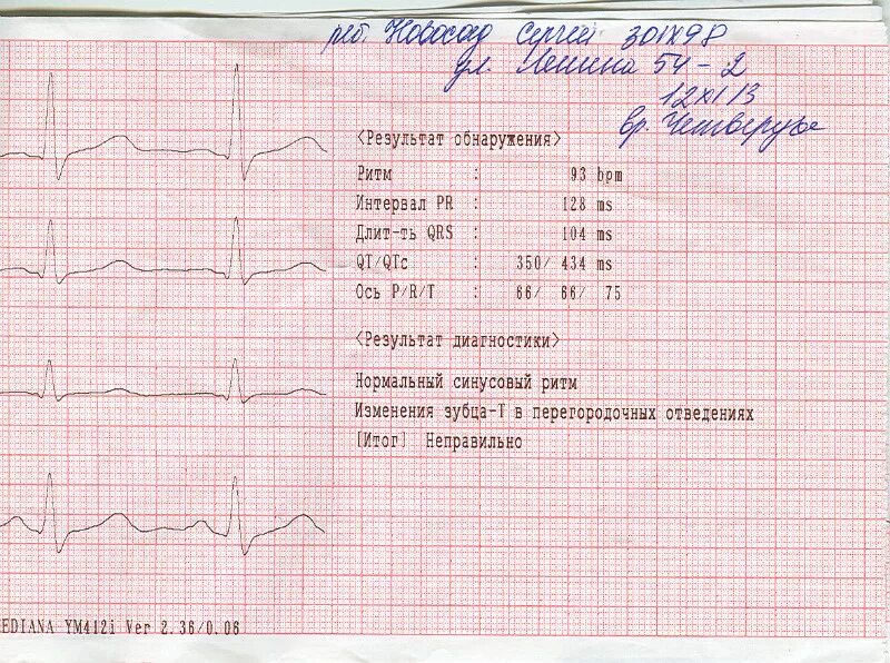 Расшифровка кардиограммы сердца онлайн по фото бесплатно Рисунок кардиограммы здорового человека