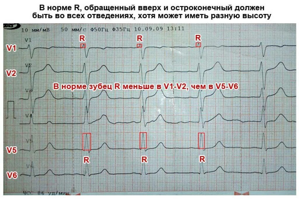 Расшифровка кардиограммы сердца онлайн по фото бесплатно Картинки КАРДИОГРАММА СЕРДЦА РАСШИФРОВКА ФОТО