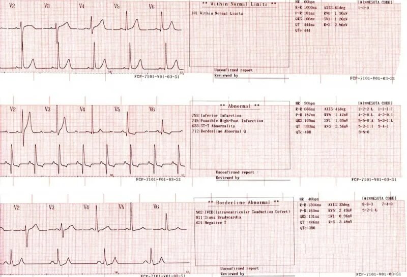 Расшифровка кардиограммы сердца у взрослых по фото Электрокардиограф Fukuda FCP-7101 купить по цене 0 руб. Медик-Сервис