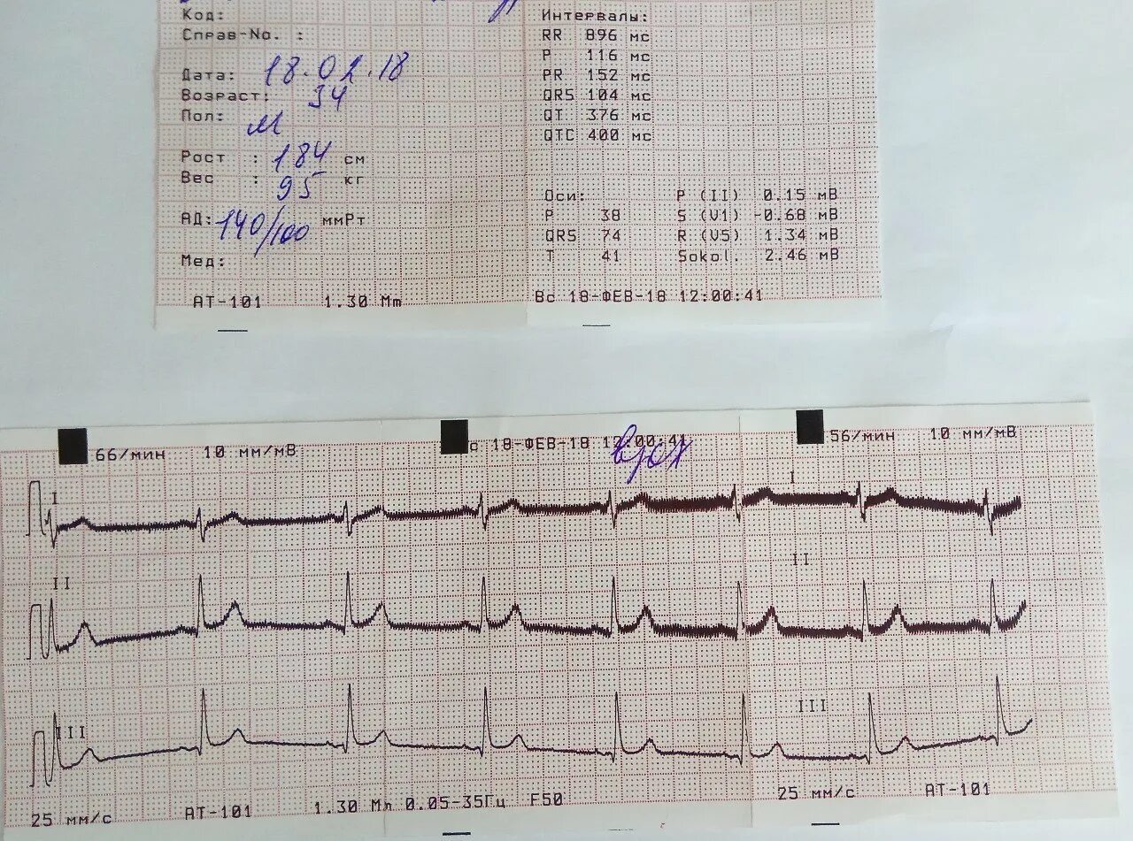 Расшифровка кардиограммы сердца у взрослых по фото Экг с расшифровкой рядом: найдено 68 изображений