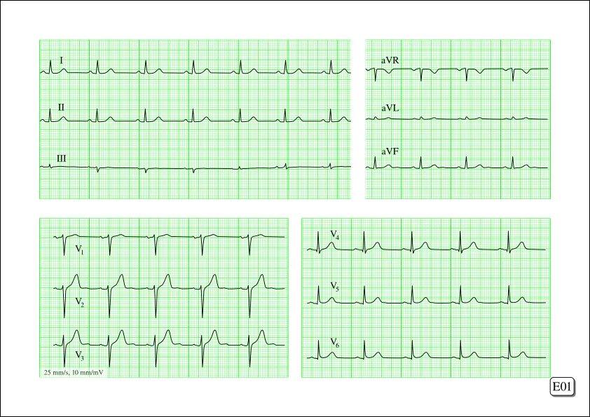 Расшифровка кардиограммы сердца у взрослых по фото Creation of an ECG workbook with Scribus