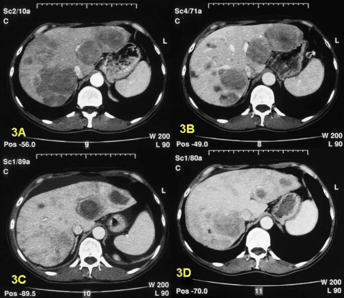 Расшифровка кт печени фото Local treatment in unresectable hepatic metastases of carcinoid tumors: Experien