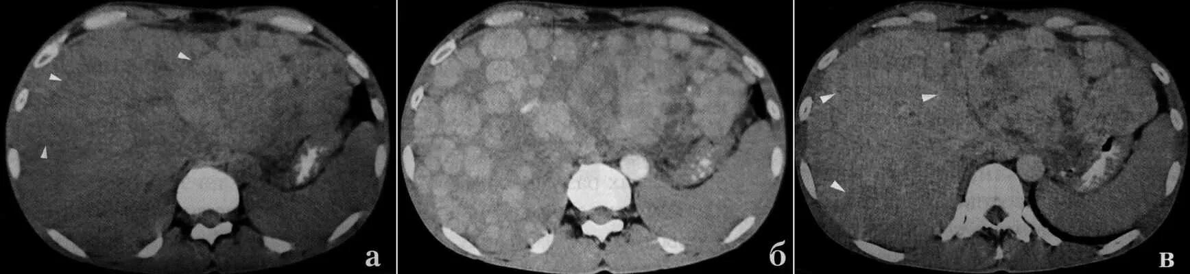 Расшифровка кт печени фото Кт мтс