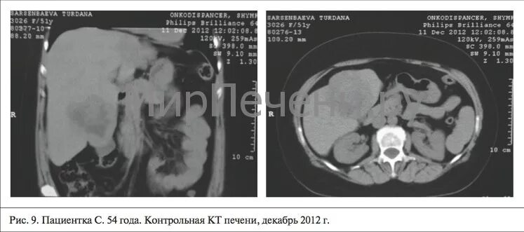 Расшифровка кт печени фото Что показывает КТ печени с контрастированием: насколько эффективно в диагностике