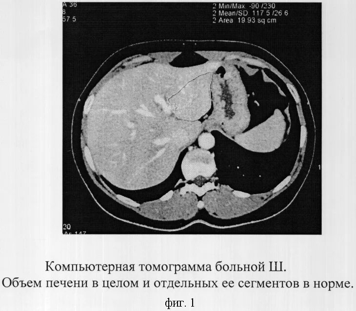 Расшифровка кт печени фото СПОСОБ КОМПЬЮТЕРНО-ТОМОГРАФИЧЕСКОЙ ДИАГНОСТИКИ АНОМАЛИЙ РАЗВИТИЯ ПЕЧЕНИ. Российс