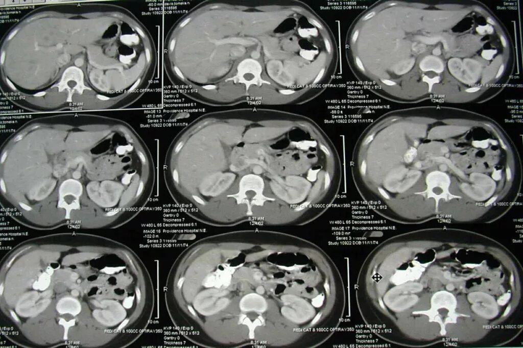 Расшифровка кт печени фото Что показывает КТ органов брюшной полости - этапы процедуры