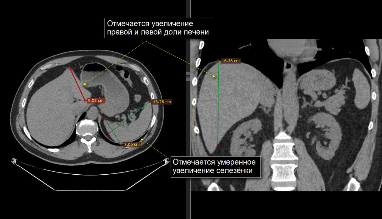 Расшифровка кт печени фото Гепатомегалия на КТ Второе мнение