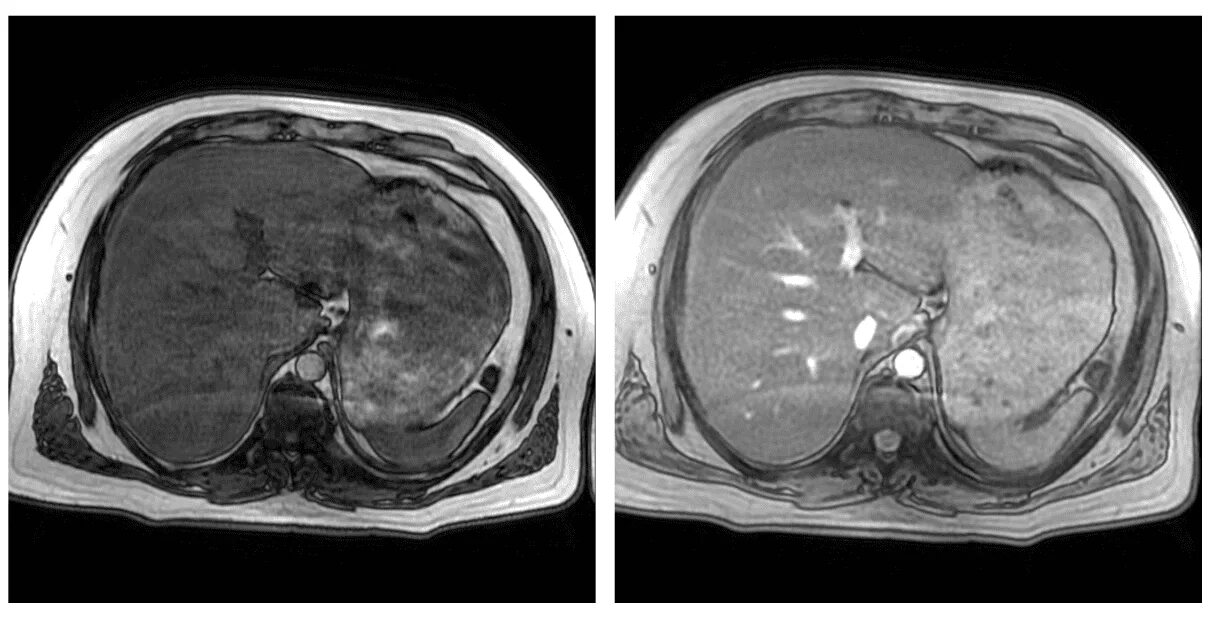 Расшифровка кт печени фото МРТ печени в клинике А2Мед