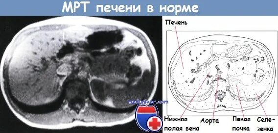 Расшифровка кт печени фото Печень - анатомия, топография